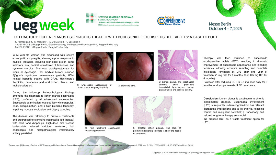 REFRACTORY LICHEN PLANUS ESOPHAGITIS TREATED WITH BUDESONIDE ORODISPERSIBLE TABLETS: A CASE REPORT