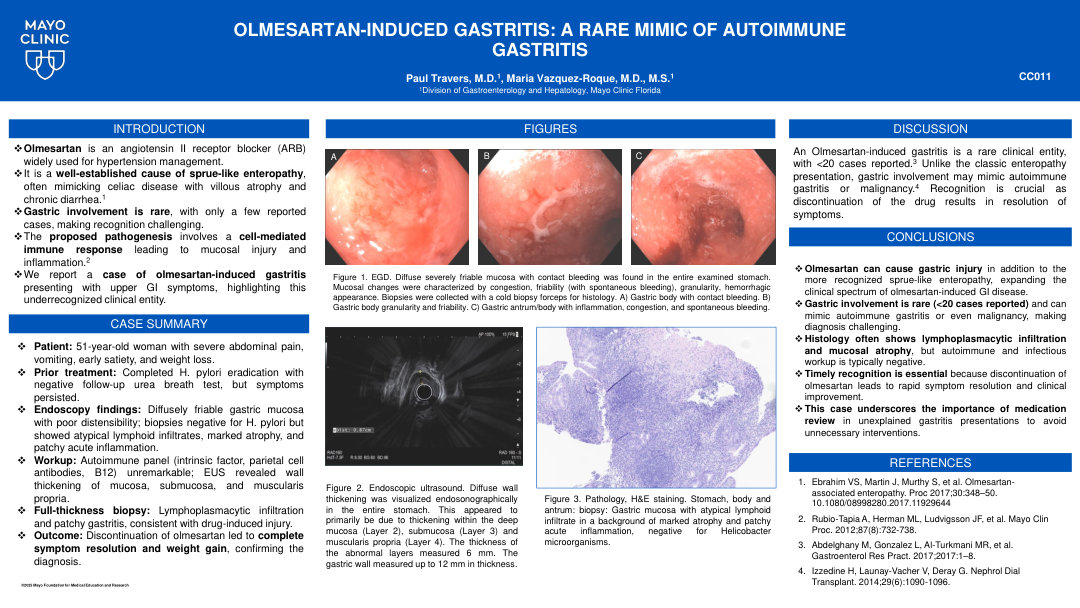 OLMESARTAN-INDUCED GASTRITIS: A RARE MIMIC OF AUTOIMMUNE GASTRITIS