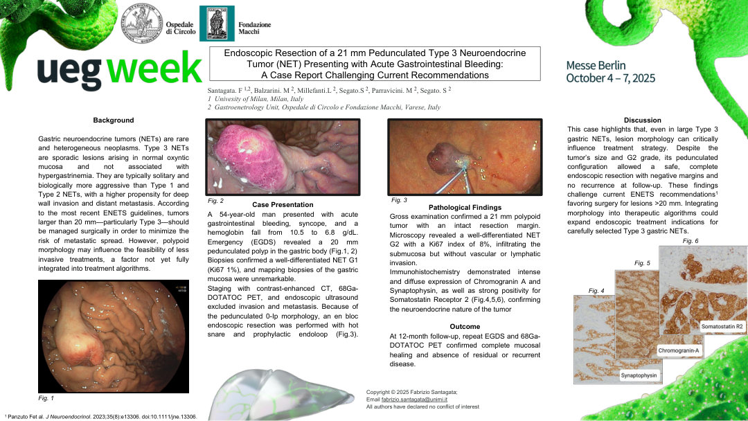 ENDOSCOPIC RESECTION OF LARGE PEDUNCULATED TYPE 3 NEUROENDOCRINE TUMOR (NET) PRESENTING WITH ACUTE GASTROINTESTINAL BLEEDING: A CASE REPORT CHALLENGING CURRENT RECOMMENDATIONS