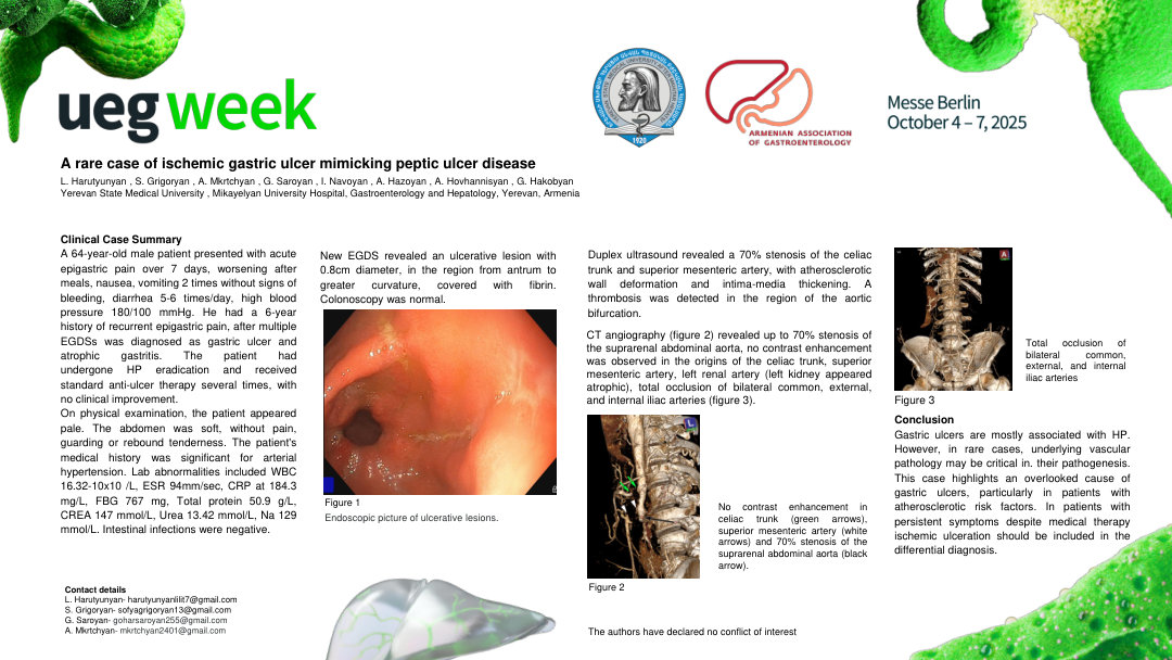A RARE CASE OF ISCHEMIC GASTRIC ULCER MIMICKING PEPTIC ULCER DISEASE