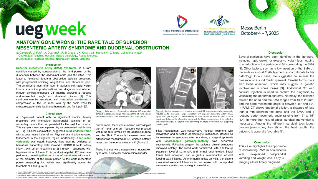 ANATOMY GONE WRONG: THE RARE TALE OF SUPERIOR MESENTERIC ARTERY SYNDROME AND DUODENAL OBSTRUCTION