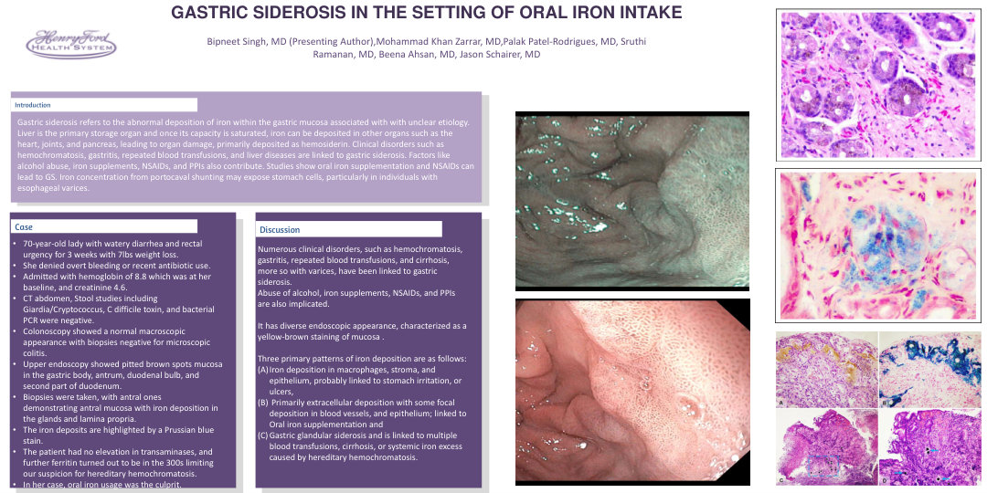 GASTRIC SIDEROSIS IN THE SETTING OF ORAL IRON INTAKE