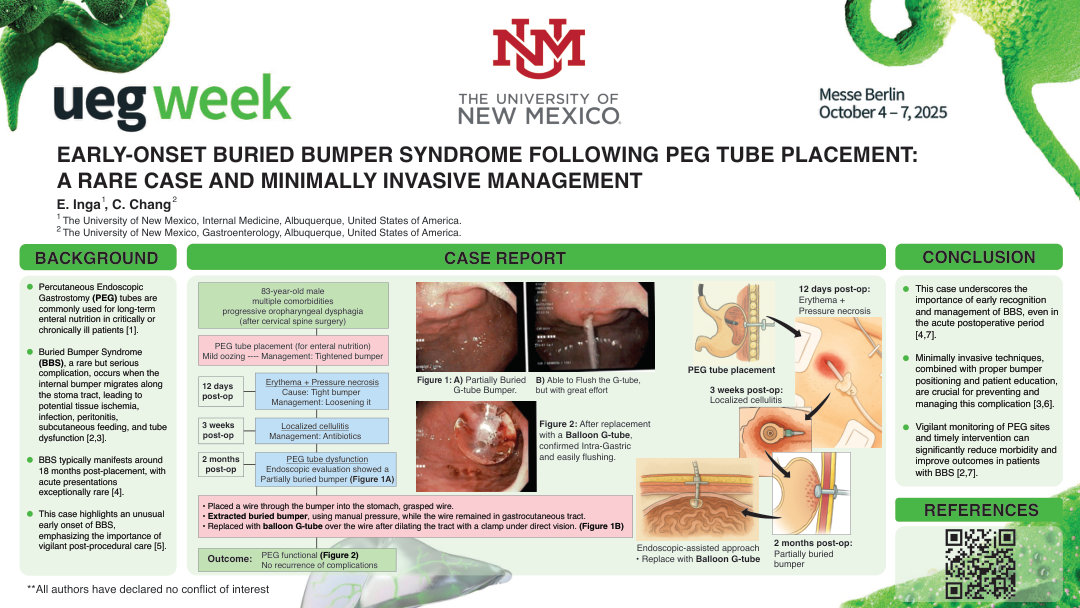EARLY-ONSET BURIED BUMPER SYNDROME FOLLOWING PEG TUBE PLACEMENT: A RARE CASE AND MINIMALLY INVASIVE MANAGEMENT