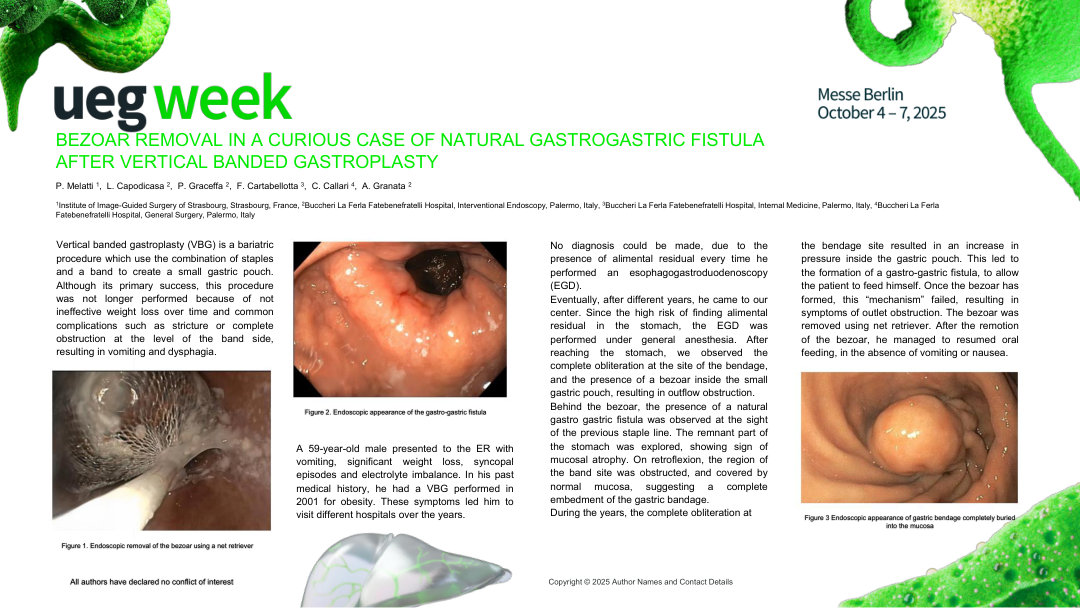 BEZOAR REMOVAL IN A CURIOUS CASE OF NATURAL GASTROGASTRIC FISTULA AFTER VERTICAL BANDED GASTROPLASTY