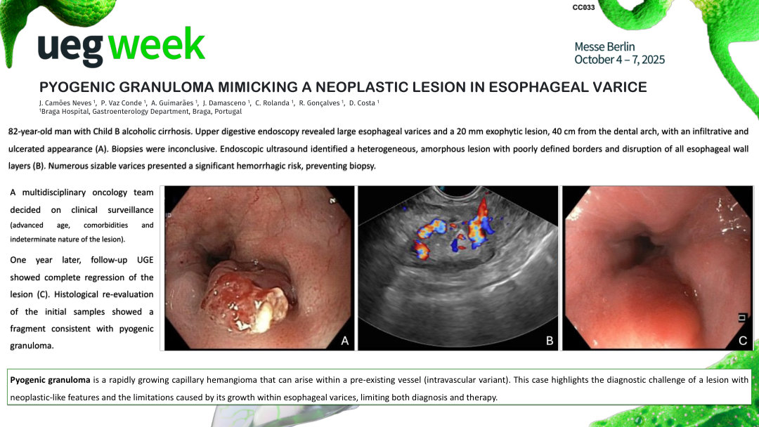 PYOGENIC GRANULOMA MIMICKING A NEOPLASTIC LESION IN ESOPHAGEAL VARICE