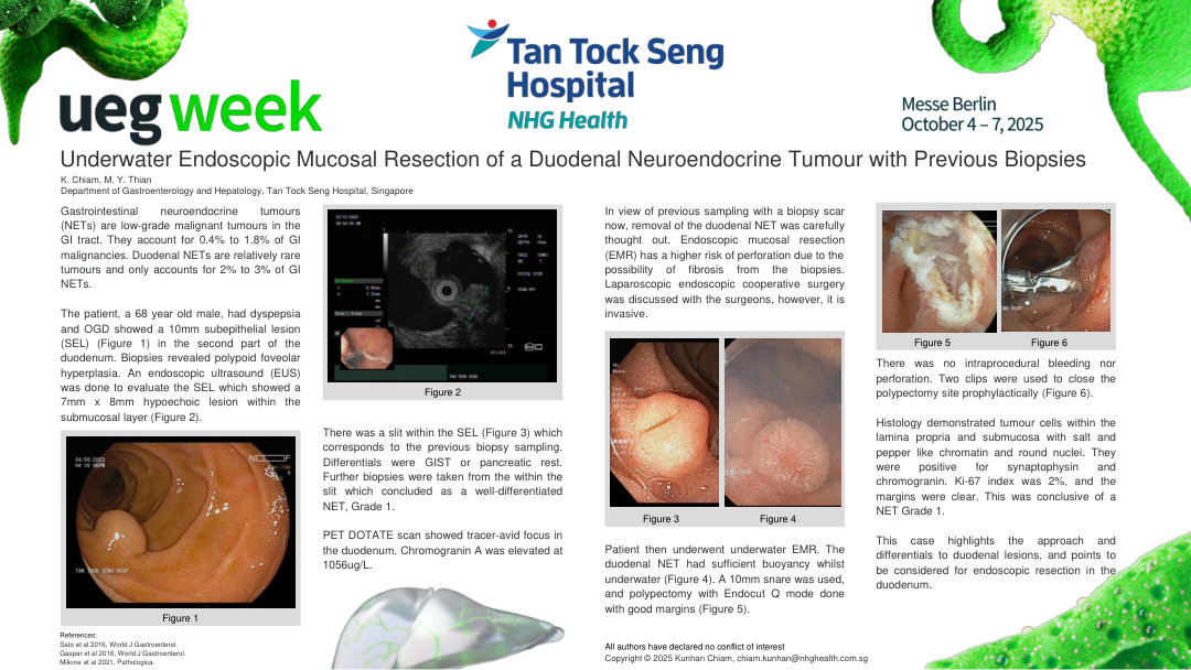 UNDERWATER ENDOSCOPIC MUCOSAL RESECTION OF A DUODENAL NEUROENDOCRINE TUMOUR WITH PREVIOUS BIOPSIES
