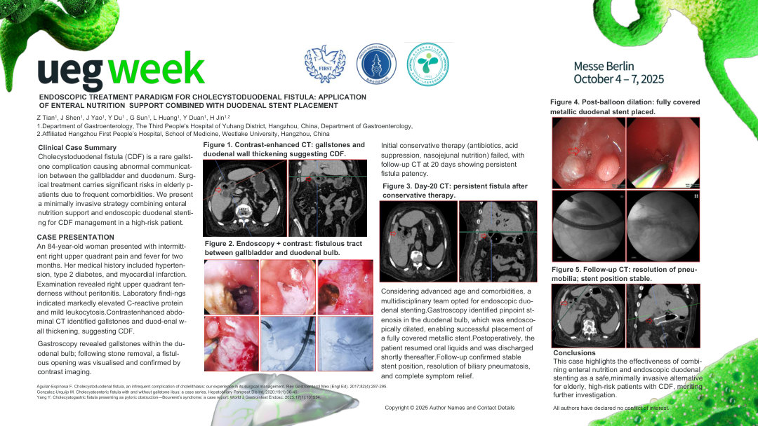 ENDOSCOPIC TREATMENT PARADIGM FOR CHOLECYSTODUODENAL FISTULA: APPLICATION OF ENTERAL NUTRITION SUPPORT COMBINED WITH DUODENAL STENT PLACEMENT