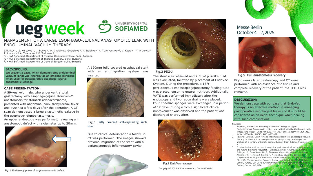 MANAGEMENT OF A LARGE ESOPHAGO-JEJUNAL ANASTOMOTIC LEAK WITH ENDOLUMINAL VACUUM THERAPY