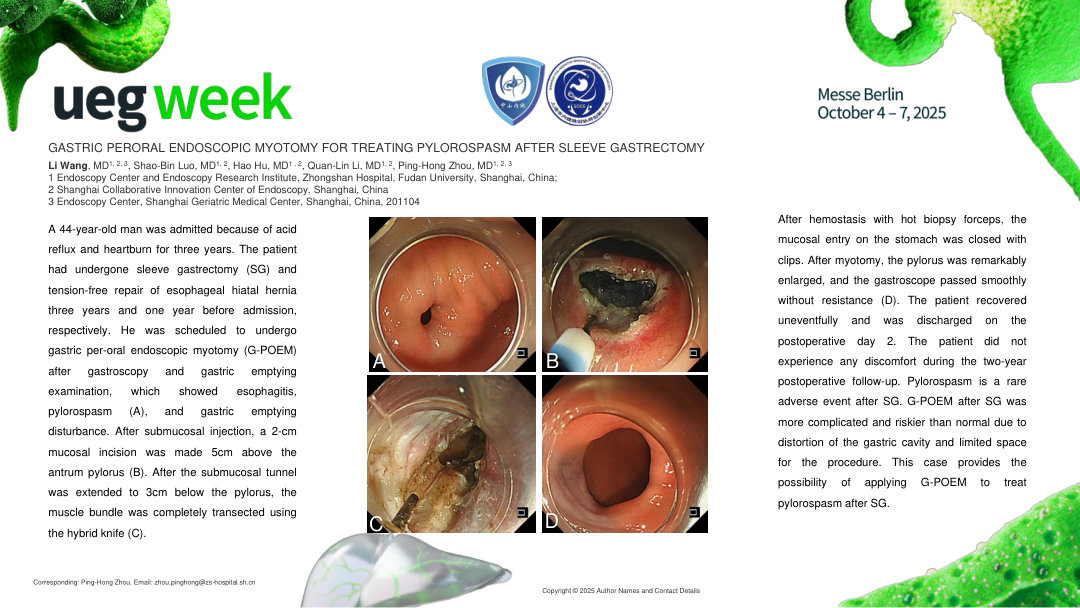GASTRIC PERORAL ENDOSCOPIC MYOTOMY FOR TREATING PYLOROSPASM AFTER SLEEVE GASTRECTOMY