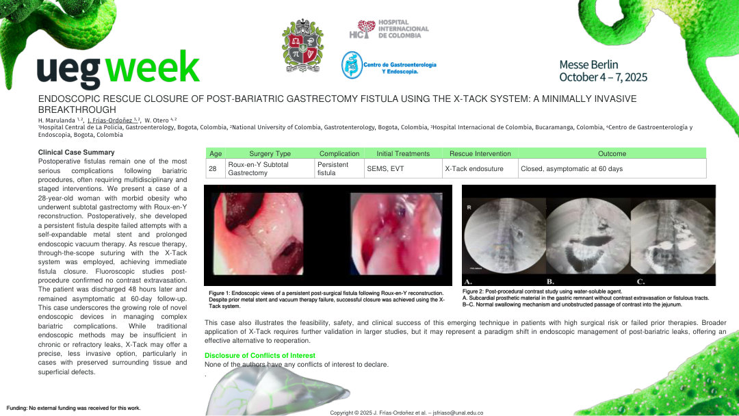 ENDOSCOPIC RESCUE CLOSURE OF POST-BARIATRIC GASTRECTOMY FISTULA USING THE X-TACK SYSTEM: A MINIMALLY INVASIVE BREAKTHROUGH