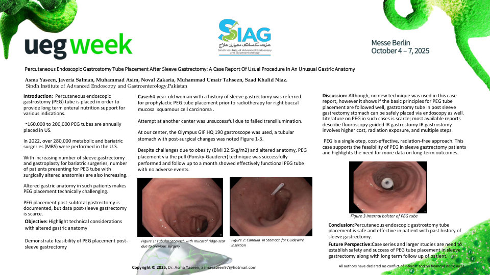 PERCUTANEOUS ENDOSCOPIC GASTROSTOMY TUBE PLACEMENT AFTER SLEEVE GASTRECTOMY: A CASE REPORT OF USUAL PROCEDURE IN AN UNUSUAL GASTRIC ANATOMY