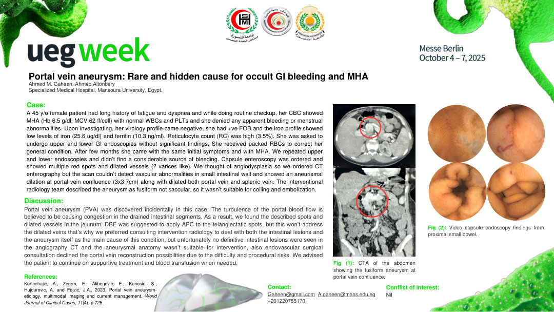 PORTAL VEIN ANEURYSM: RARE AND HIDDEN CAUSE FOR OCCULT GI BLEEDING AND MHA