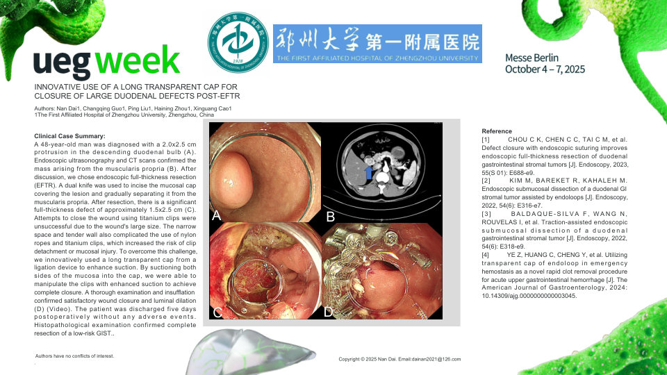 INNOVATIVE USE OF A LONG TRANSPARENT CAP FOR CLOSURE OF LARGE DUODENAL DEFECTS POST-EFTR