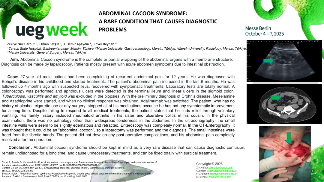 ABDOMINAL CACOON SYNDROME: A RARE CONDITION THAT CAUSES DIAGNOSTIC PROBLEMS