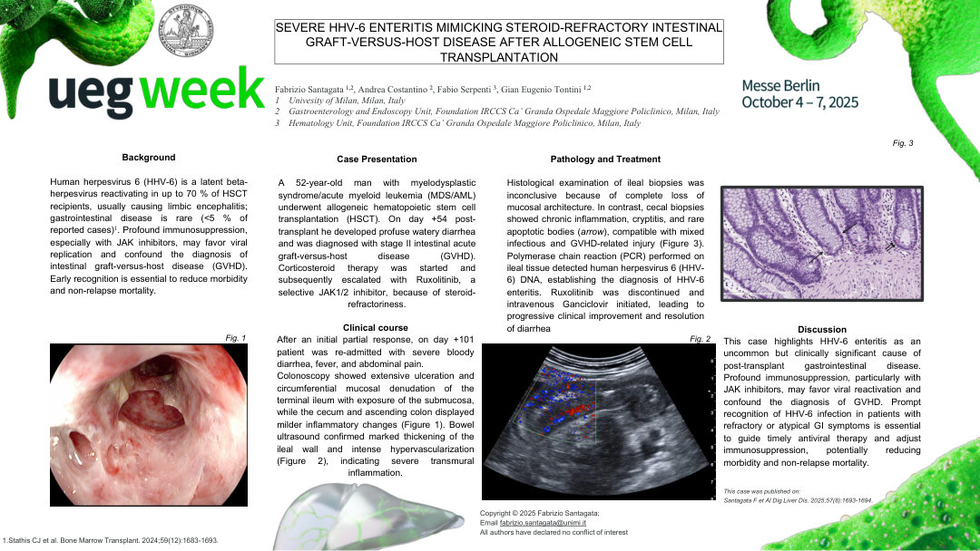 SEVERE HHV-6 ENTERITIS MIMICKING STEROID-REFRACTORY INTESTINAL GRAFT-VERSUS-HOST DISEASE AFTER ALLOGENEIC STEM CELL TRANSPLANTATION
