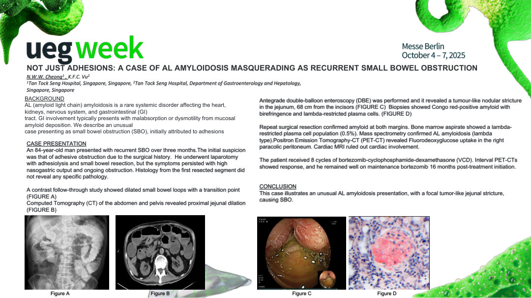 NOT JUST ADHESIONS: A CASE OF AL AMYLOIDOSIS MASQUERADING AS RECURRENT SMALL BOWEL OBSTRUCTION
