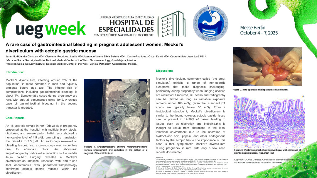 A RARE CASE OF GASTROINTESTINAL BLEEDING IN PREGNANT ADOLESCENT WOMEN: MECKEL’S DIVERTICULUM WITH ECTOPIC GASTRIC MUCOSA