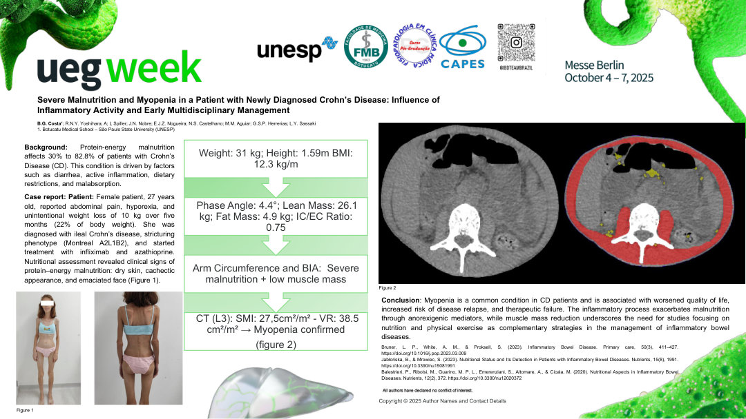 SEVERE MALNUTRITION AND MYOPENIA IN A PATIENT WITH NEWLY DIAGNOSED CROHN’S DISEASE: INFLUENCE OF INFLAMMATORY ACTIVITY AND EARLY MULTIDISCIPLINARY MANAGEMENT