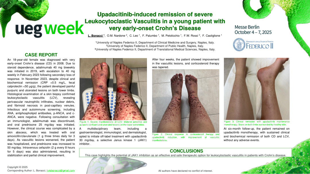 UPADACITINIB-INDUCED REMISSION OF SEVERE LEUKOCYTOCLASTIC VASCULITIS IN A YOUNG PATIENT WITH VERY EARLY-ONSET CROHN’S DISEASE