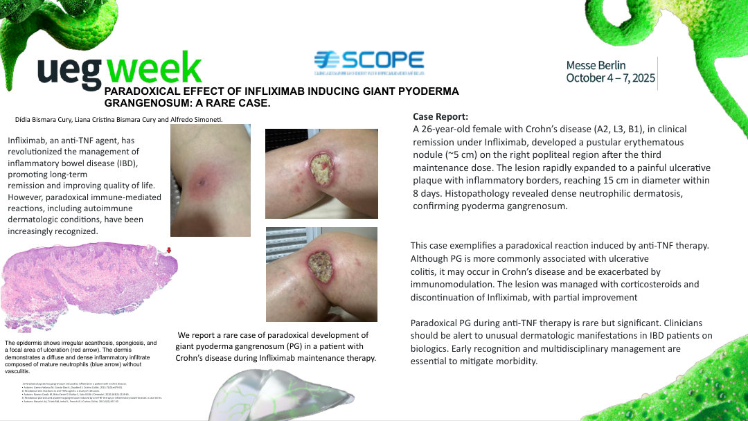 PARADOXICAL EFFECT OF INFLIXIMAB INDUCING GIANT PYODERMA GRANGENOSUM: A RARE CASE