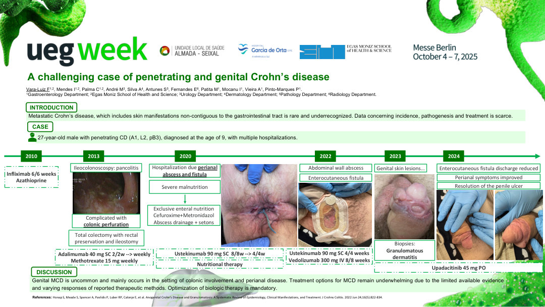 A CHALLENGING CASE OF PENETRATING AND GENITAL CROHN’S DISEASE