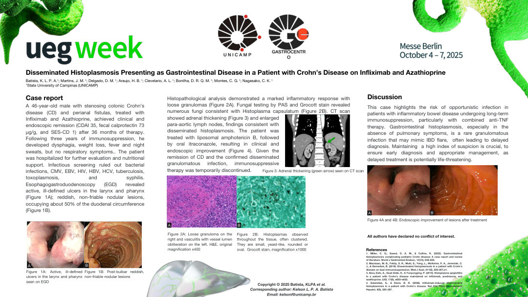 DISSEMINATED HISTOPLASMOSIS PRESENTING AS GASTROINTESTINAL DISEASE IN A PATIENT WITH CROHN’S DISEASE ON INFLIXIMAB AND AZATHIOPRINE