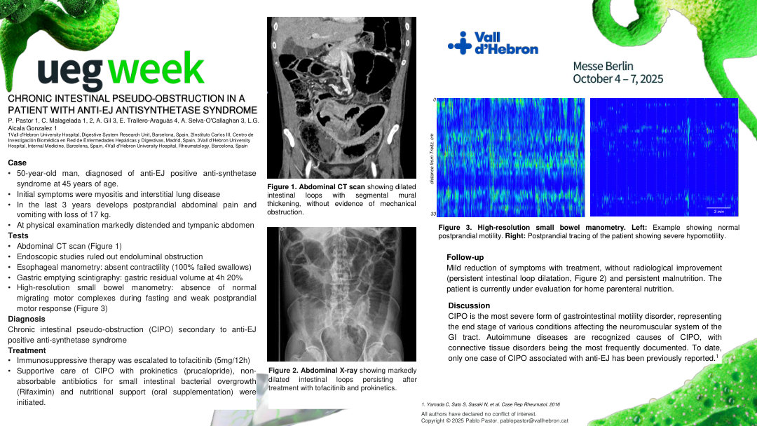 CHRONIC INTESTINAL PSEUDO-OBSTRUCTION IN A PATIENT WITH ANTI-EJ ANTISYNTHETASE SYNDROME