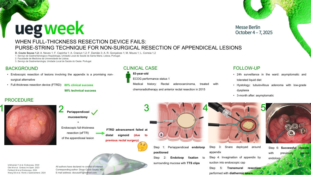 WHEN THE FULL-THICKNESS RESECTION DEVICE FAILS: PURSE-STRING TECHNIQUE FOR NON-SURGICAL RESECTION OF APPENDICEAL LESIONS