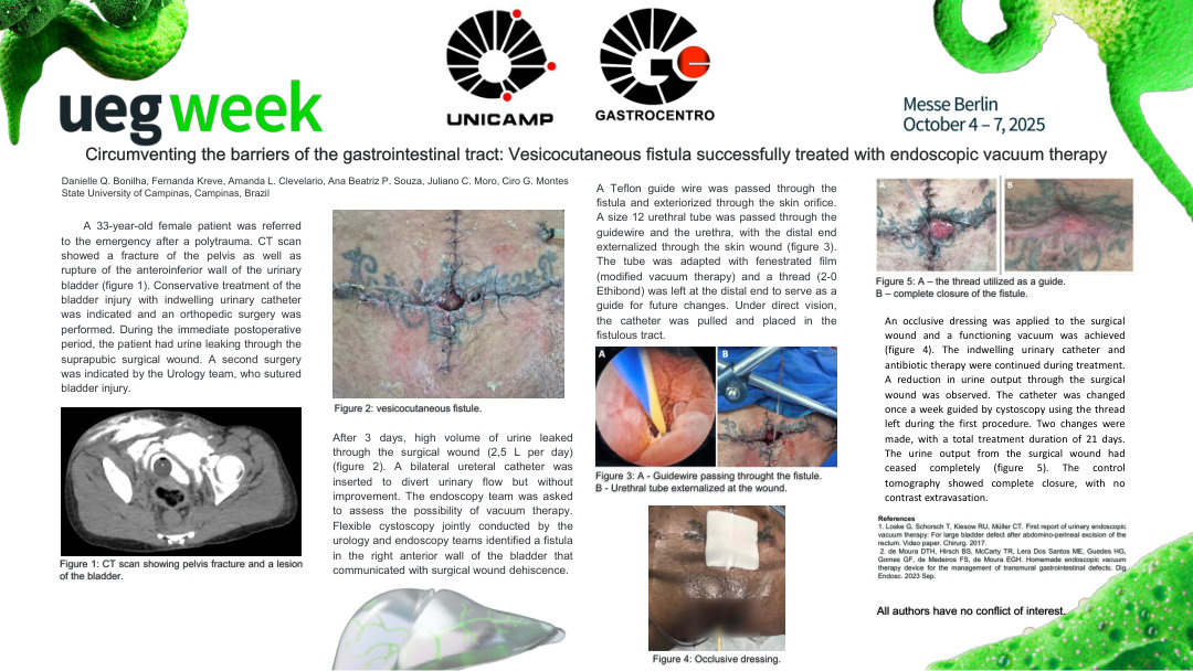 CIRCUMVENTING BARRIERS OF THE GASTROINTESTINAL TRACT: SUCCESSFUL TREATMENT OF A VESICOCUTANEOUS FISTULA WITH ENDOSCOPIC VACUUM THERAPY