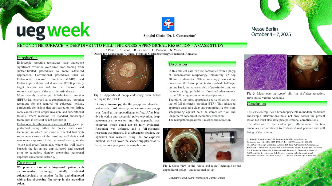 BEYOND THE SURFACE: A DEEP DIVE INTO FULL-THICKNESS APPENDICEAL RESECTION - A CASE STUDY
