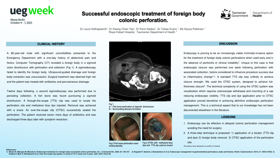 SUCCESSFUL ENDOSCOPIC TREATMENT OF FOREIGN BODY COLONIC PERFORATION