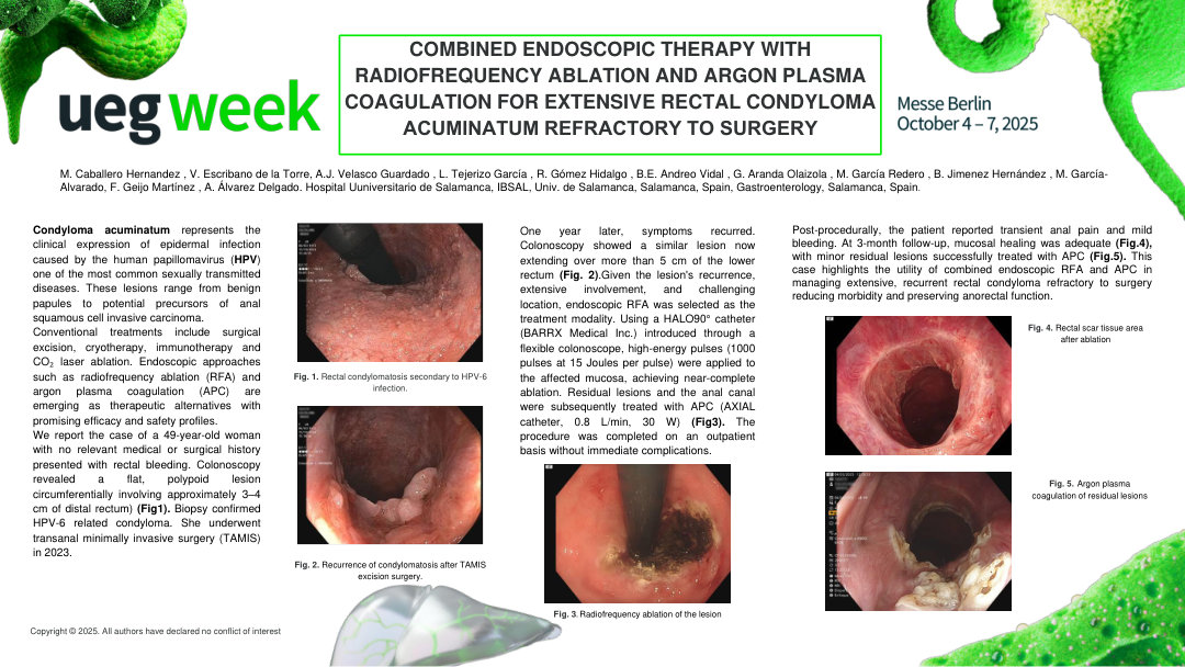 COMBINED ENDOSCOPIC THERAPY WITH RADIOFREQUENCY ABLATION AND ARGON PLASMA COAGULATION FOR EXTENSIVE RECTAL CONDYLOMA ACUMINATUM REFRACTORY TO SURGERY​​​​