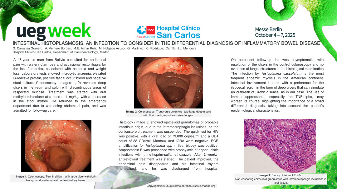 INTESTINAL HISTOPLASMOSIS, AN INFECTION TO CONSIDER IN THE DIFFERENTIAL DIAGNOSIS OF INFLAMMATORY BOWEL DISEASE