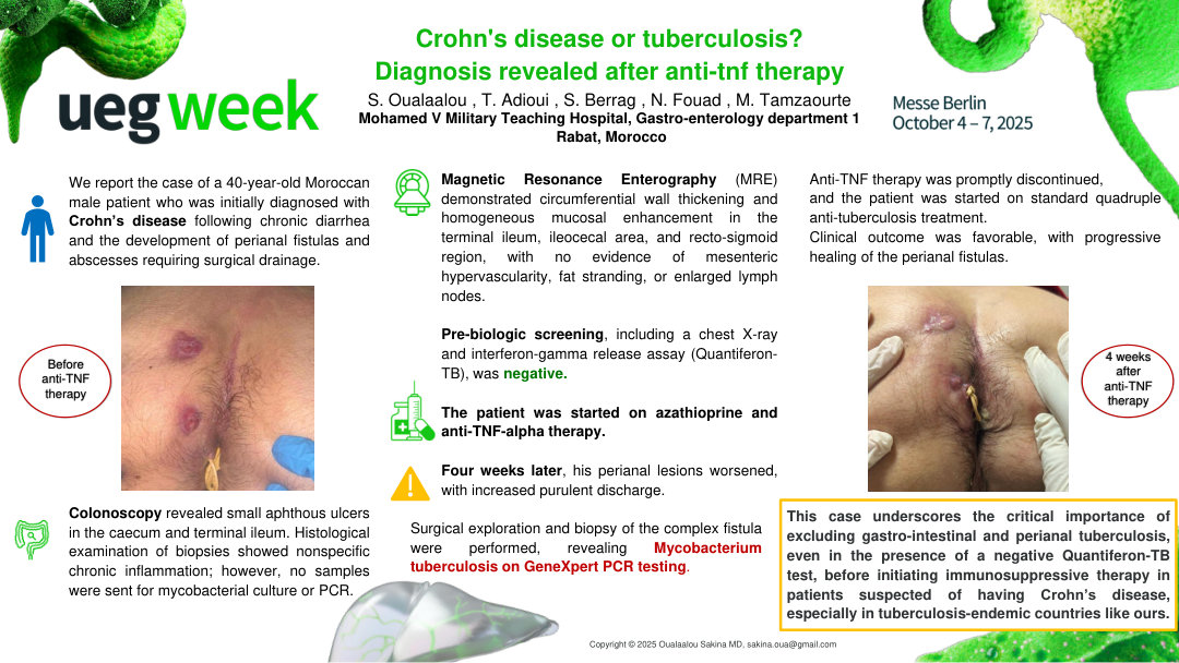CROHN'S DISEASE OR TUBERCULOSIS? DIAGNOSIS REVEALED AFTER ANTI-TNF THERAPY