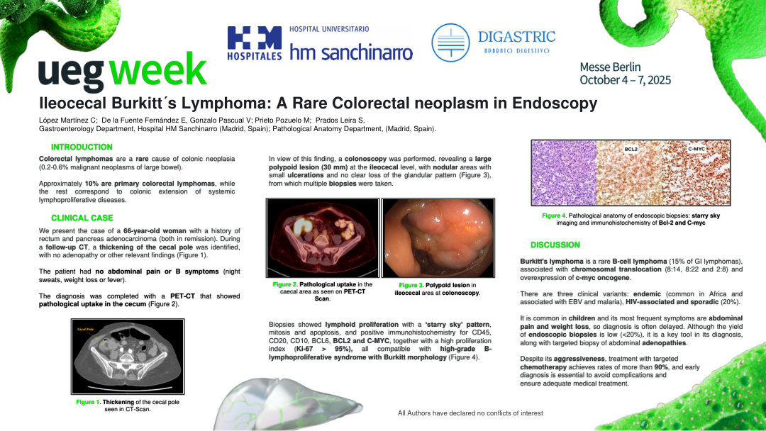 ILEOCECAL BURKITT'S LYMPHOMA: A RARE COLORECTAL NEOPLASM IN ENDOSCOPY