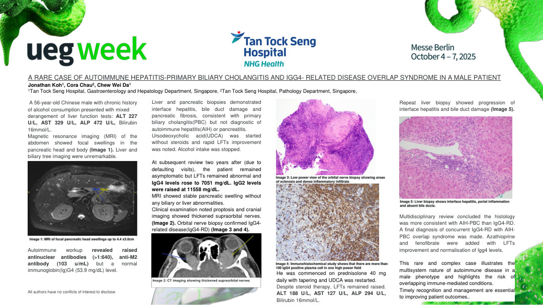 A RARE CASE OF AUTOIMMUNE HEPATITIS-PRIMARY BILIARY CHOLANGITIS AND IGG4- RELATED DISEASE OVERLAP SYNDROME IN A MALE PATIENT