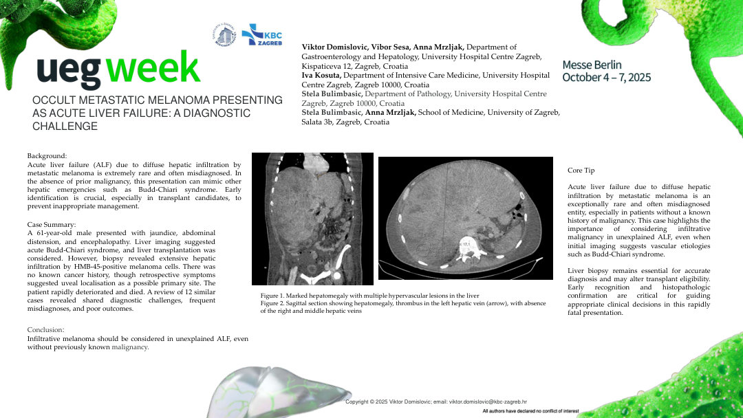 OCCULT METASTATIC MELANOMA PRESENTING AS ACUTE LIVER FAILURE: A DIAGNOSTIC CHALLENGE
