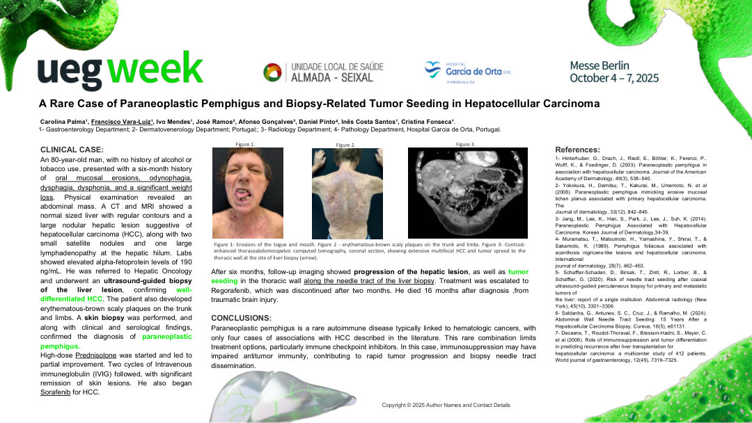 A RARE CASE OF PARANEOPLASTIC PEMPHIGUS AND BIOPSY-RELATED TUMOR SEEDING IN HEPATOCELLULAR CARCINOMA