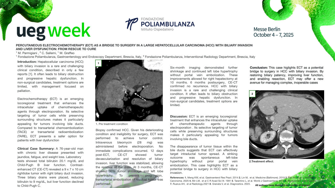 PERCUTANEOUS ELECTROCHEMOTHERAPY (ECT) AS A BRIDGE TO SURGERY IN A LARGE HEPATOCELLULAR CARCINOMA (HCC) WITH BILIARY INVASION AND LIVER DYSFUNCTION: FROM RESCUE TO CURE