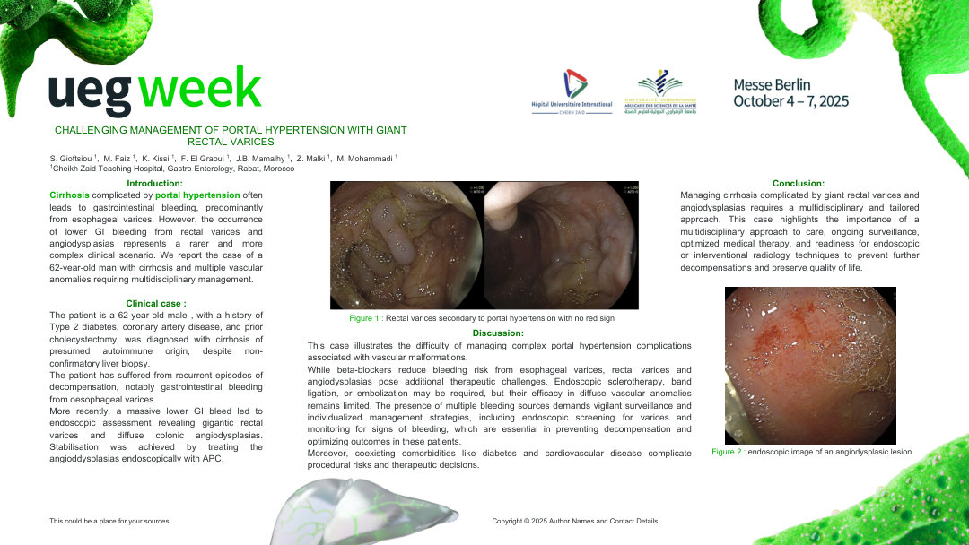 CHALLENGING MANAGEMENT OF PORTAL HYPERTENSION WITH GIANT RECTAL VARICES
