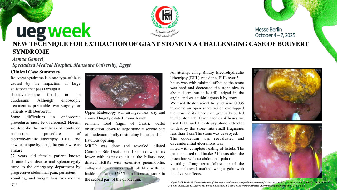 NEW TECHNIQUE FOR EXTRACTION OF GIANT STONE IN A CHALLENGING CASE OF BOUVERT SYNDROME