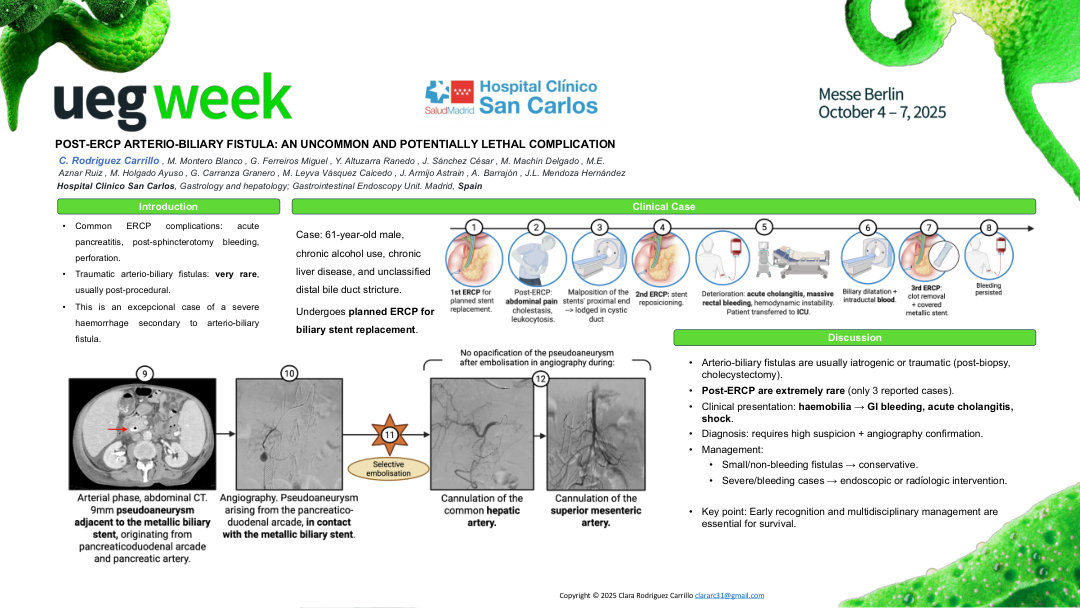POST-ERCP ARTERIO-BILIARY FISTULA: AN UNCOMMON AND POTENTIALLY LETHAL COMPLICATION