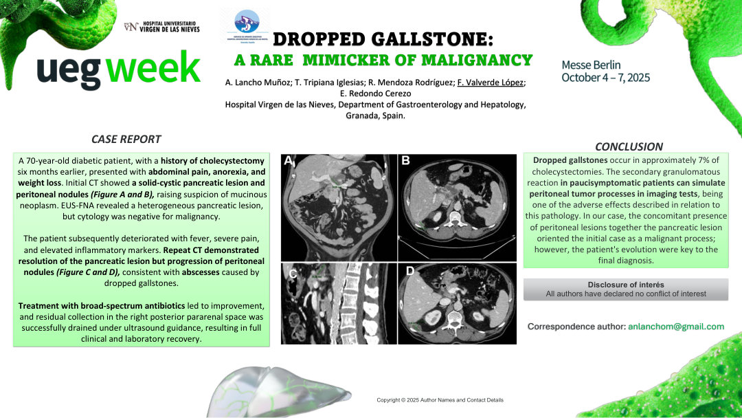 DROPPED GALLSTONES: A RARE MIMICKER OF MALIGNANCY