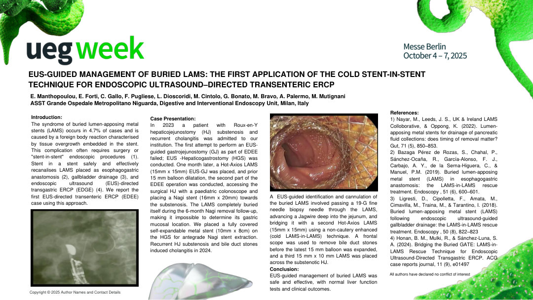 EUS-GUIDED MANAGEMENT OF BURIED LAMS: THE FIRST APPLICATION OF THE COLD STENT-IN-STENT TECHNIQUE FOR ENDOSCOPIC ULTRASOUND–DIRECTED TRANSENTERIC ERCP