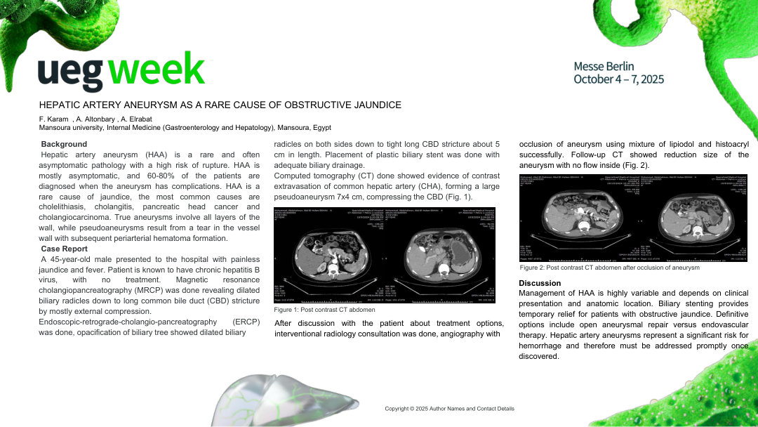 HEPATIC ARTERY ANEURYSM AS A RARE CAUSE OF OBSTRUCTIVE JAUNDICE