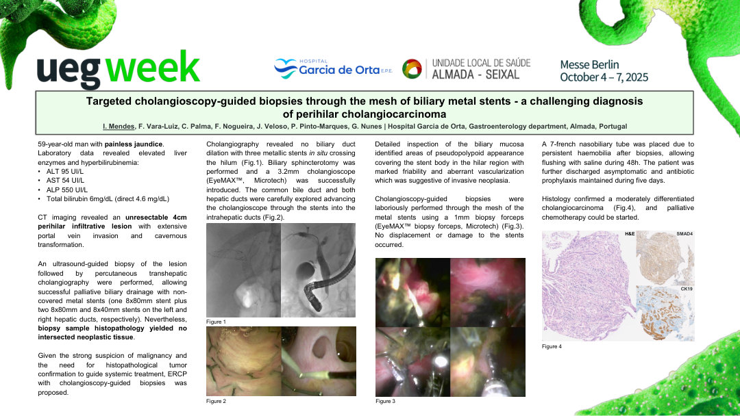TARGETED CHOLANGIOSCOPY-GUIDED BIOPSIES THROUGH THE MESH OF BILIARY METAL STENTS - A CHALLENGING DIAGNOSIS OF PERIHILAR CHOLANGIOCARCINOMA