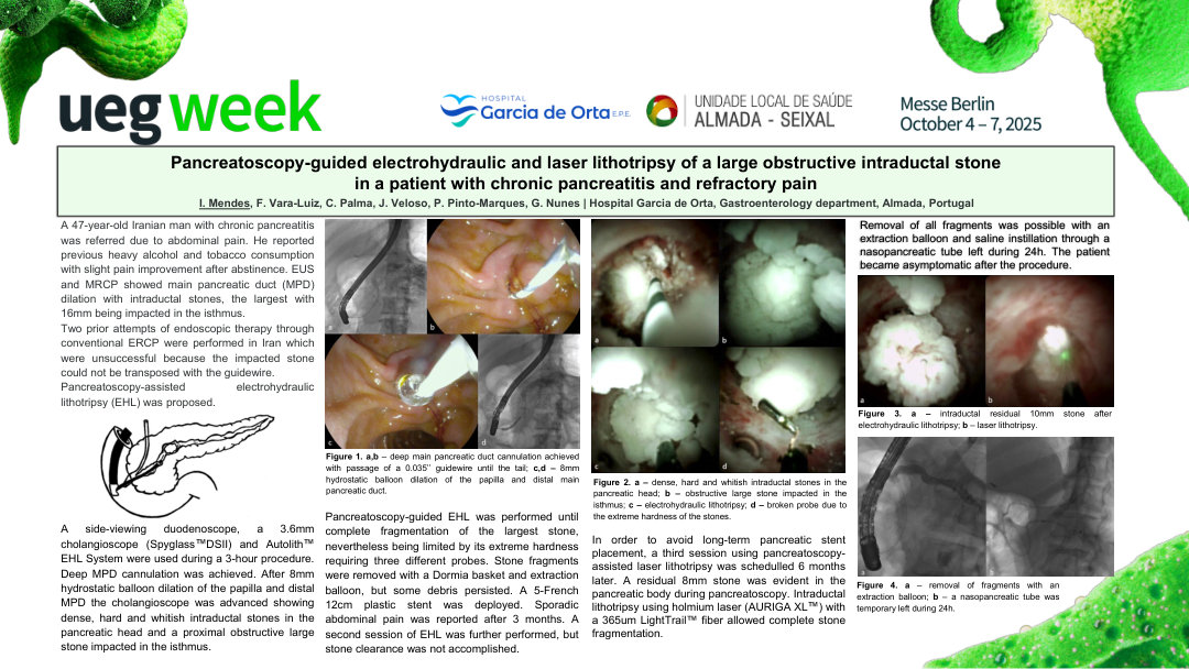 PANCREATOSCOPY-GUIDED ELECTROHYDRAULIC AND LASER LITHOTRIPSY OF A LARGE OBSTRUCTIVE INTRADUCTAL STONE IN A PATIENT WITH CHRONIC PANCREATITIS AND REFRACTORY PAIN