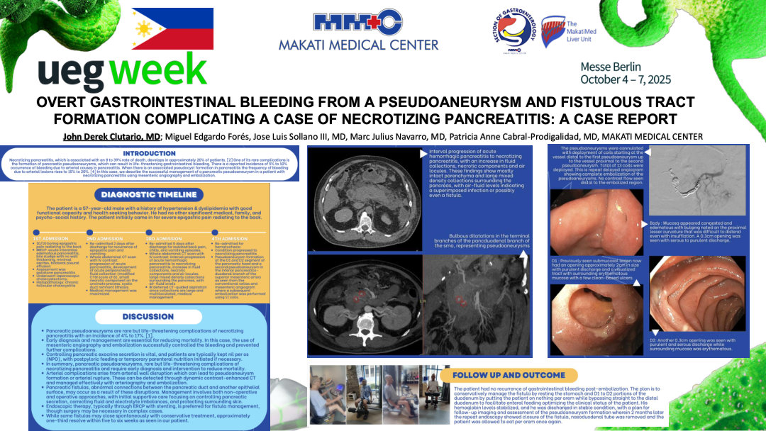 OVERT GASTROINTESTINAL BLEEDING FROM A PSEUDOANEURYSM AND FISTULOUS TRACT FORMATION COMPLICATING A CASE OF NECROTIZING PANCREATITIS: A CASE REPORT