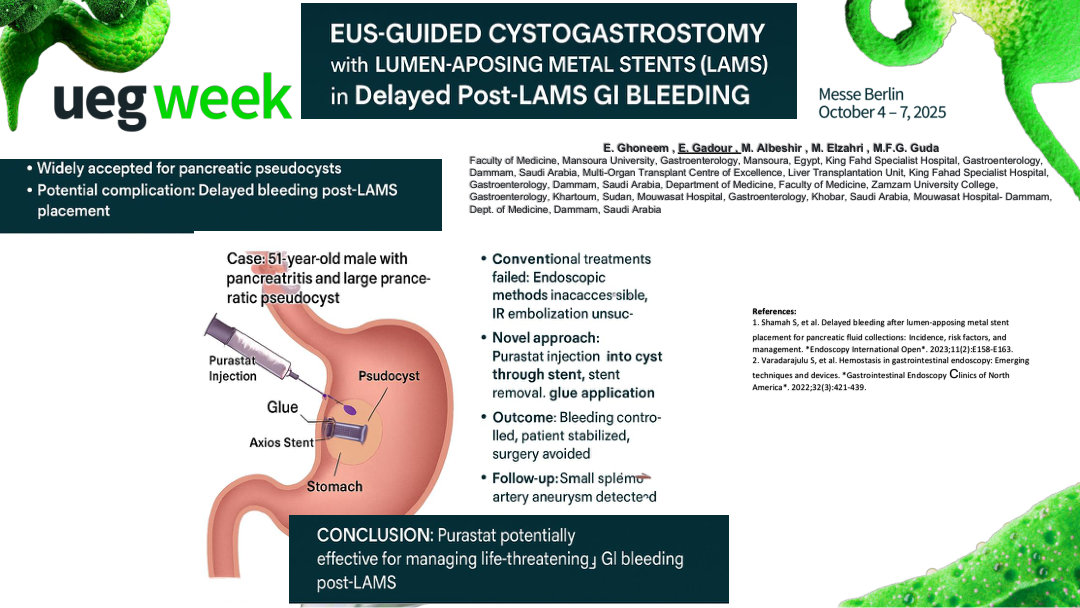 ENDOSCOPIC HEMOSTASIS WITH PURASTAT INJECTION FOR UNCONTROLLED BLEEDING AFTER LUMEN-APPOSING METAL STENT PLACEMENT: A CASE STUDY