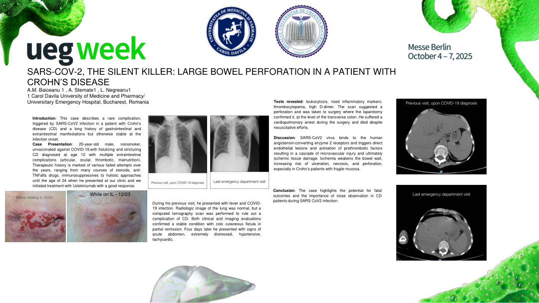SARS-COV-2, THE SILENT KILLER: LARGE BOWEL PERFORATION IN A PATIENT WITH CROHN’S DISEASE